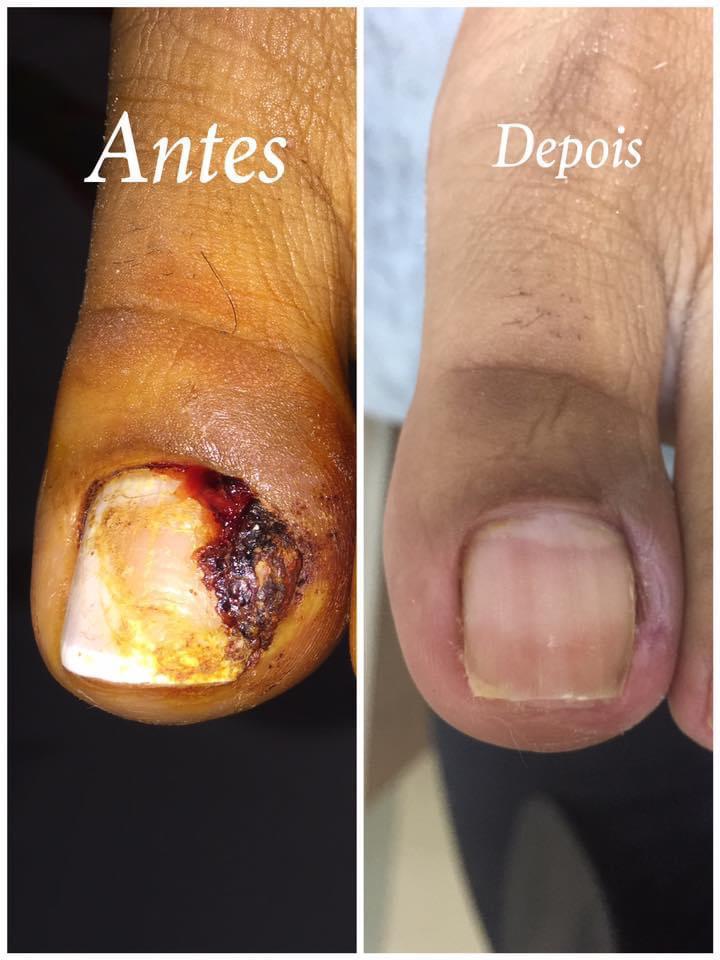 Transformação tratamento podológico