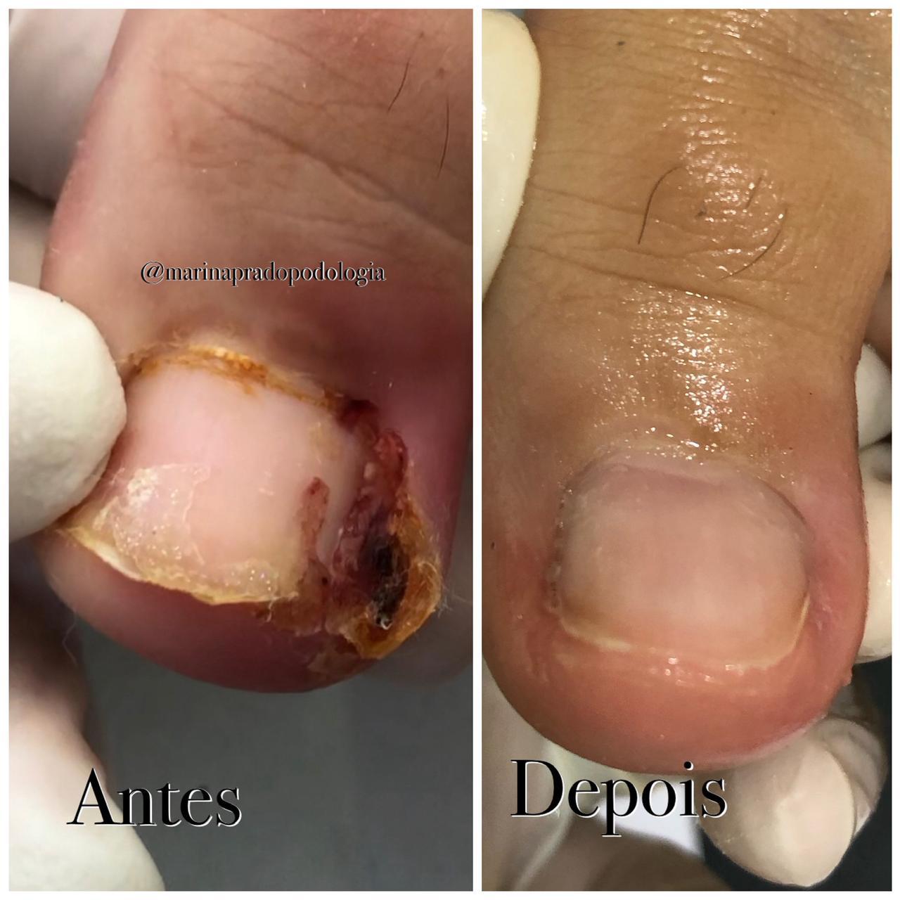 Resultado antes e depois