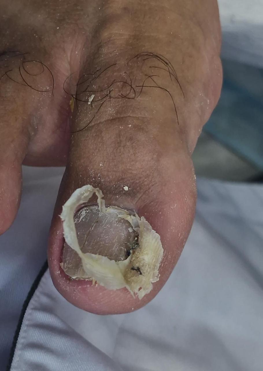 Resultado tratamento podológico 1