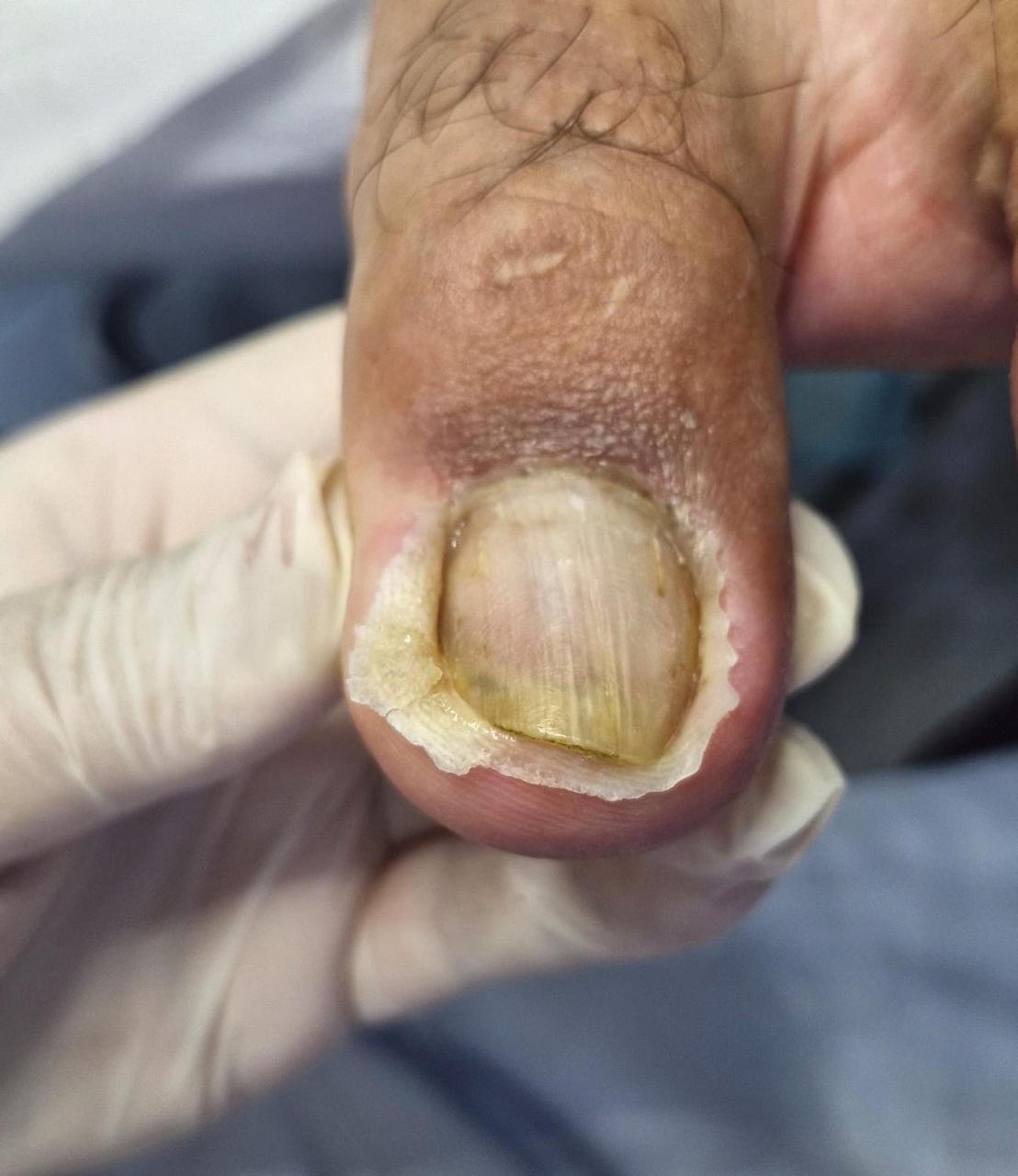 Resultado tratamento podológico 2