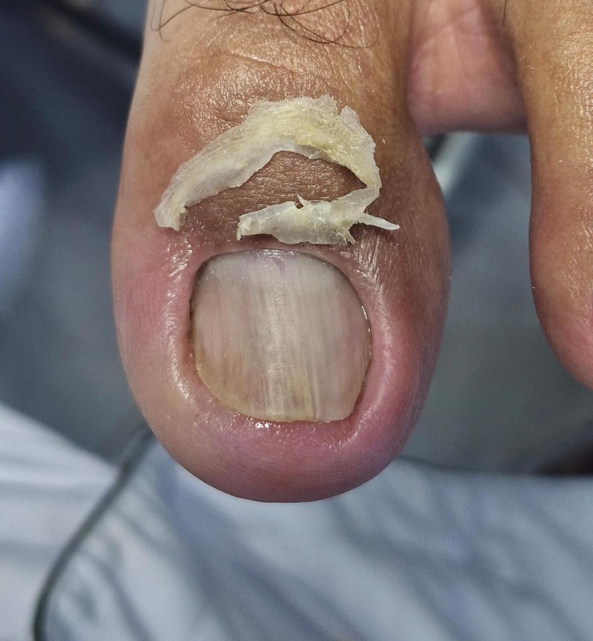 Resultado tratamento podológico 3