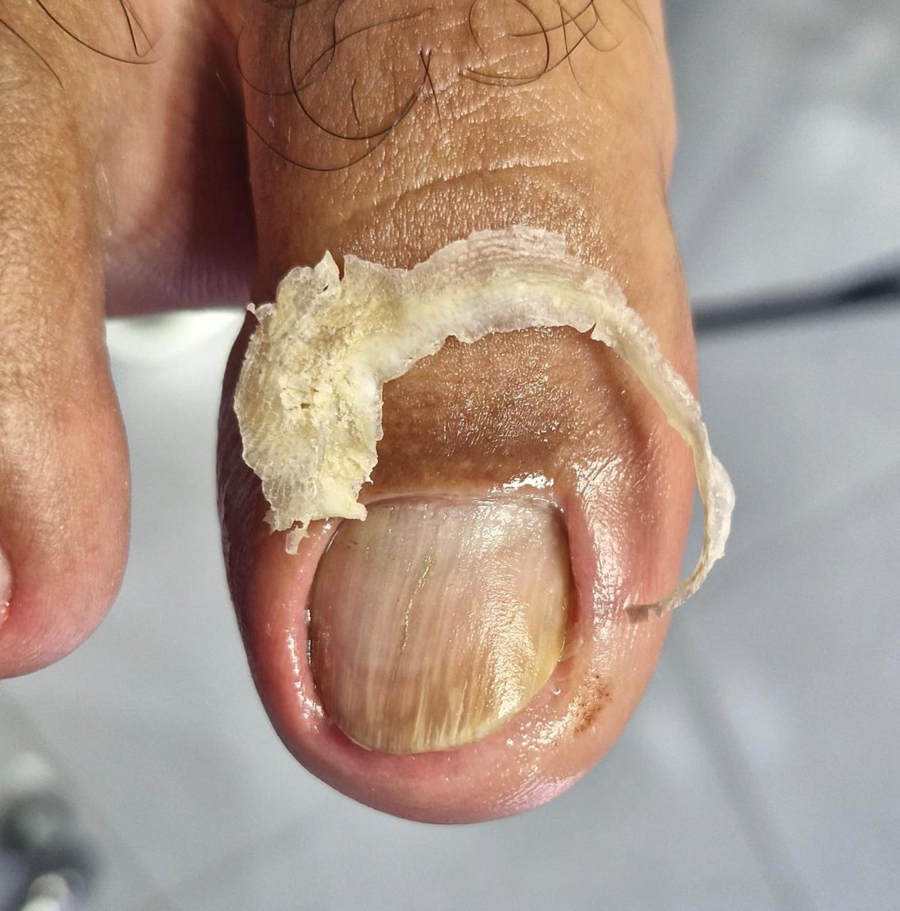 Resultado tratamento podológico 4