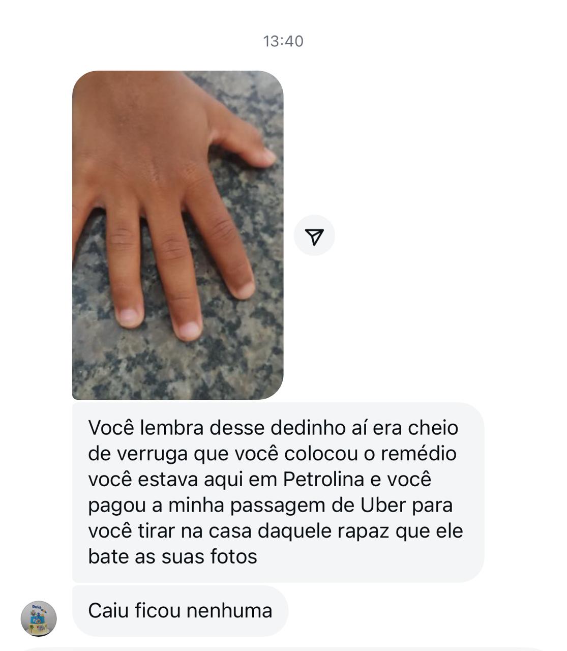 Depoimento Tratamento Verruga - Resultado impressionante