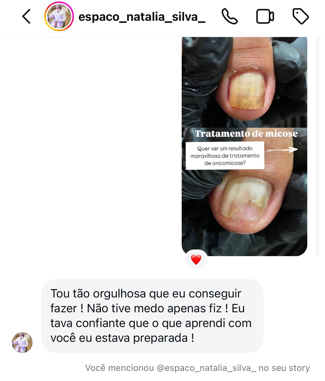 Depoimento Natalia Silva - Resultado maravilhoso onicomicose